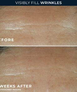 Alternative view of RETINOL CORREXION® Deep Wrinkle Filler